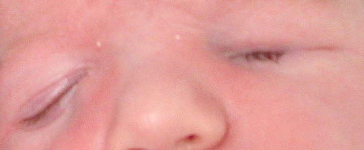 protesi oculare neonato